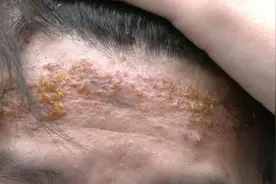 烫发有风险？一小伙做“烟花烫”被烧伤，额头烫成这样图片