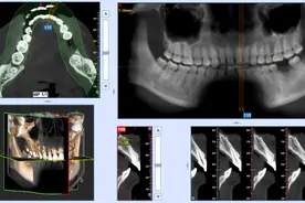 自体牙移植 | 牙医让智齿变废为宝图片