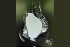 女生初二了还没来月经，腹痛难忍错过期末考试，竟是因为“大姨妈”被堵住了图片