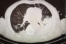 浙江一男子用鸡粪施肥，结果感染重症肺炎住进ICU！专家节前提醒：接触禽类要注意图片