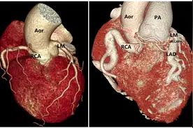 广州医生手绘5张精美手术图，独创术式治好先天性心脏病图片