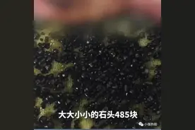 春节千万要注意！28岁男子体内被取出485块石头，平时喜欢暴饮暴食、喝酒、熬夜图片