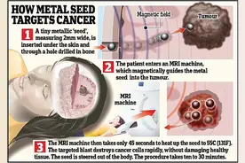 新法治癌：小钢球经MRI引导至肿瘤，迅速加热并炸毁癌细胞图片