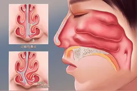 鼻子里红红的 “肉疙瘩”是什么？图片