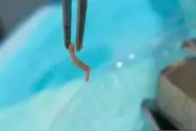 广东一小伙牙疼去拔牙，揪出1厘米长活虫图片