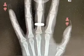 瞬间撬断指骨！医生视角告诉你，美甲有多厉害……图片