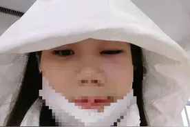 满哥帮忙 | 女子注射玻尿酸后肿成大小眼，涉事机构曾被陈乔恩起诉判赔图片