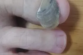 脚趾上长了个“牡蛎”？每走一步，都像被人用钳子狠狠地夹了一下图片