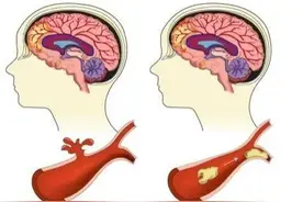 【佑安-神内系列科普】危害严重，佑安医院提示您脑血管病危害大要重视图片