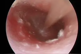 “啊？我没听清”孩子分泌性中耳炎，别错过早期预警图片