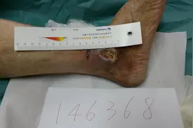 热水泡脚两次，脚踝泡出脓疱？专家提醒这些人不适合泡脚图片