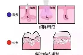 济南海峡整形科普：关于红蓝光祛痘，你了解吗？图片
