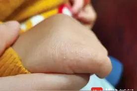 孩子手背小疙瘩反复挠痒，警惕“摩擦性苔藓样疹”图片