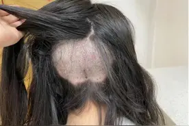 植发广告真“坑”人！大麦微针、新生植发被投诉图片