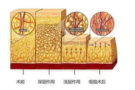「吸脂后遗症」吸脂很容易触及到的“雷点”图片