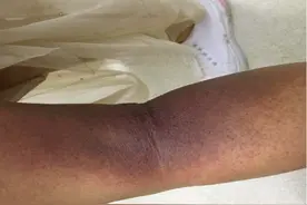 杭州阿姨大腿遭“袭击”，痛成这样！家中常见的它最近频频出动，防范注意这几点图片