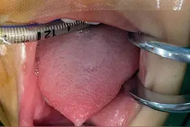 注意！小朋友的“舌筋”到底要不要剪？开屏新闻帮你问了专家图片