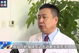 我国特应性皮炎患者超过7000万，专家提醒图片