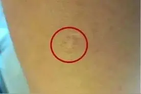 那么，为什么打了疫苗会有“花”呢？没有留下疤痕是没起作用吗？图片