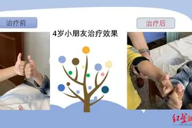 孩子字迹扭曲，拇指屈伸不利…可能是得了小儿狭窄性腱鞘炎图片