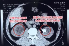 男子反复腰痛苦撑2个月，差点因此“毁”了肾图片