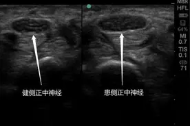 手发麻？可能是这个问题图片