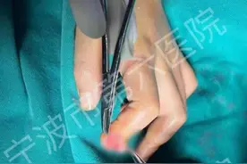 9岁男孩咬指甲致甲沟炎持续流脓，进展成骨髓炎险些截指图片