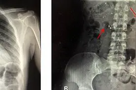 误吞水银，这样做可以救命图片