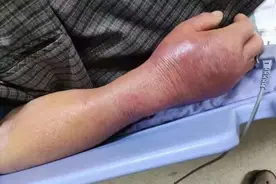 生吃三文鱼险丧命 感染了什么细菌这么吓人图片