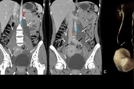 盆腔神秘肿块竟是6厘米大的特殊肿瘤！一妇婴王育团队巧手“抽丝剥茧”图片