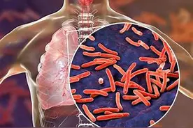 不遵医嘱自行停药，七旬嗲嗲全身多处感染结核图片