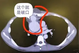 健身小伙胸口鼓“大包”，幸运“拆弹”获新生图片