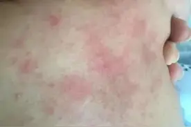 湿疹鼻炎浑身痒，娃三天两头跑医院！原来，是这个病……图片