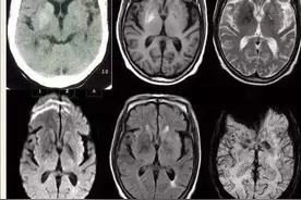 难受！杭州84岁奶奶不停“跳舞”，一查跟这些习惯有关……图片