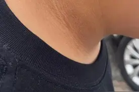 脖子发黑，9岁男孩查出3种病，医生警告→图片