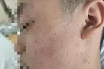 血小板减少症男孩反复出血 中山七院采用脾切除术成功救治图片