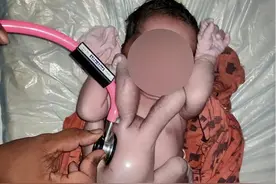 印度女婴出生时有4条胳膊和4条腿，被誉为“大自然的奇迹”图片