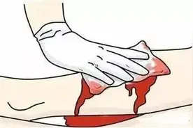 血流不止时，你知道怎么正确止血吗？快进来学习图片