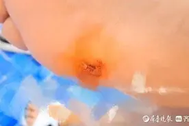 事发泰安虎山公园游泳池，花500元办理会员卡，刚下水脚被扎破图片