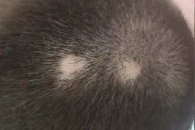 一夜之间头上秃了好几块，斑秃真的是“鬼剃头”吗图片