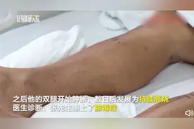 湖南一男子被蚊子叮咬十几个包，患脓毒症进ICU，医生紧急提醒图片