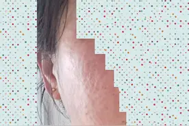 35岁女子注射水光针，差点毁容图片