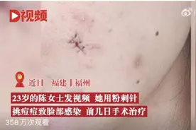女子挤痘痘致脸部感染缝了6针！还有人因此进ICU…为啥挤痘这么危险？忍不住咋办？图片