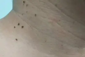 西安小伙脖子上长“小肉揪”，居然是HPV感染......图片