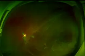 18岁男孩视网膜脱离险致盲，600度以上高度近视都需警惕图片