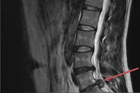 28岁杭州小伙为练出八块腹肌狂健身，没想到这里严重受伤图片