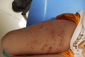 男孩海边游泳遭“电击”，上岸后无法站立！医生提醒图片