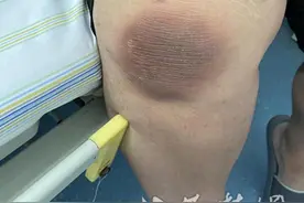 270斤男子因肥胖只能“跪姿”睡觉一年 来汉做完减重手术后终于能正常入睡了图片