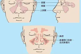 鼻窦炎忽视不得！影响孩子身高、智力发育图片