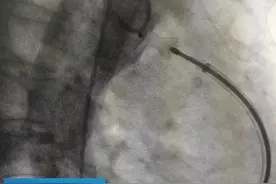 女子劳累后胸闷心悸、呼吸困难，竟是心脏有“漏洞”图片